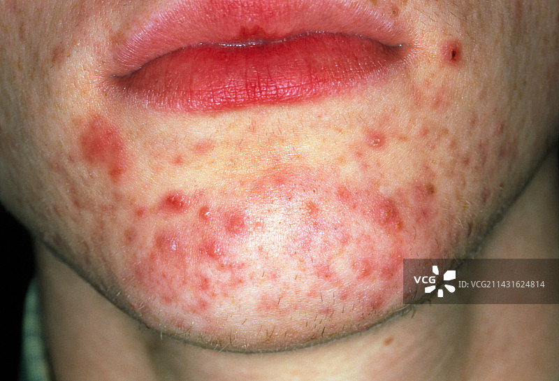 下巴上的粉刺图片素材