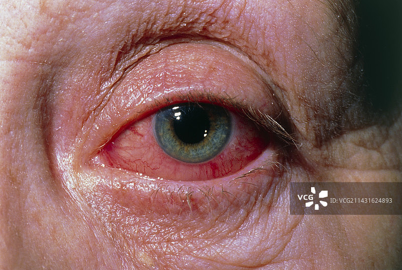 严重的过敏性结膜炎图片素材