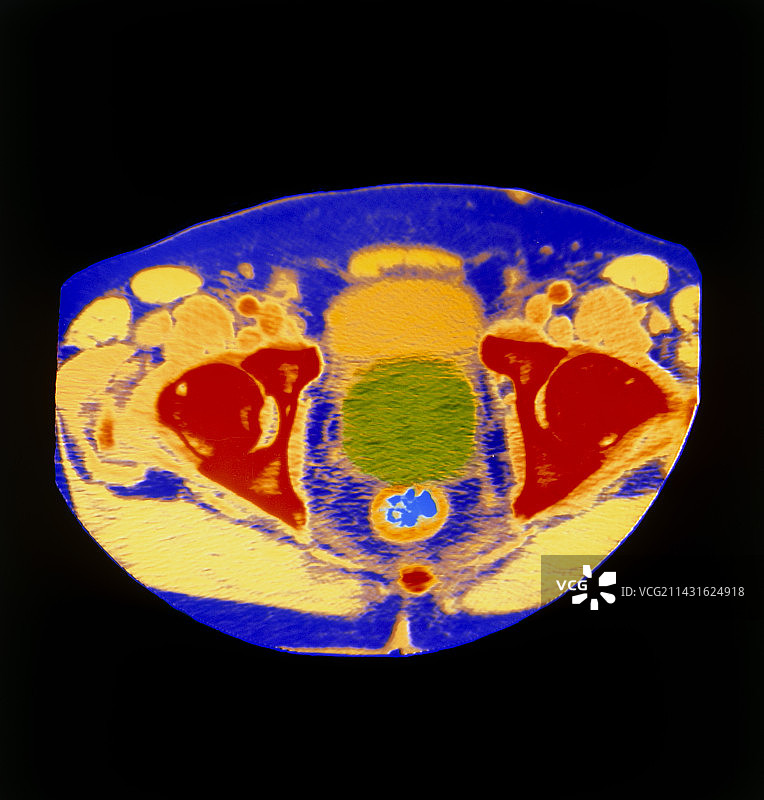 前列腺癌CT扫描影像图片素材