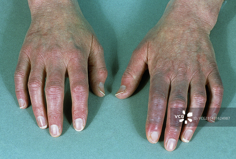 患有雷诺氏病的人的手图片素材