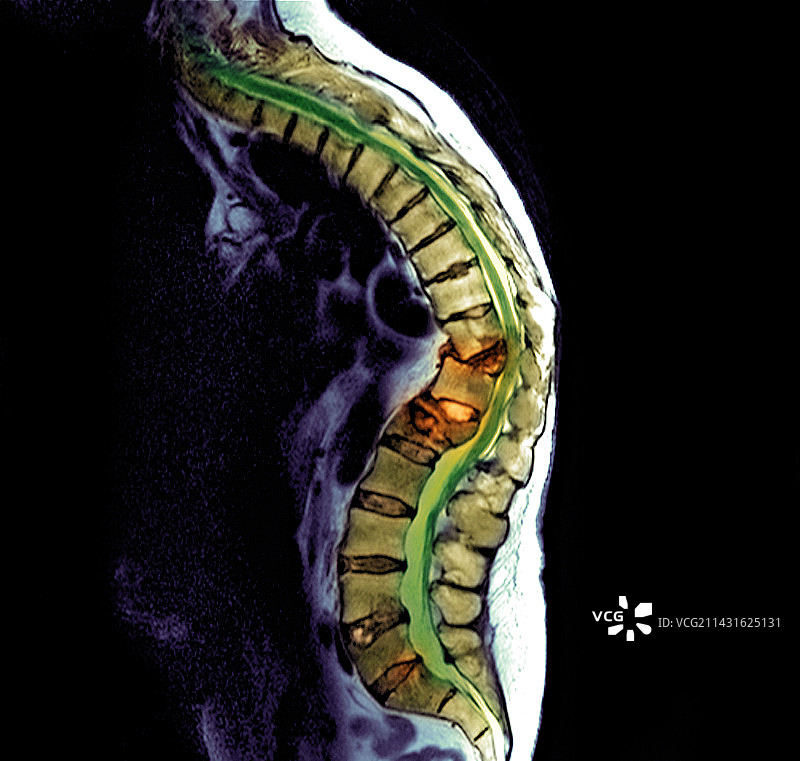 继发性骨癌MRI扫描图片素材