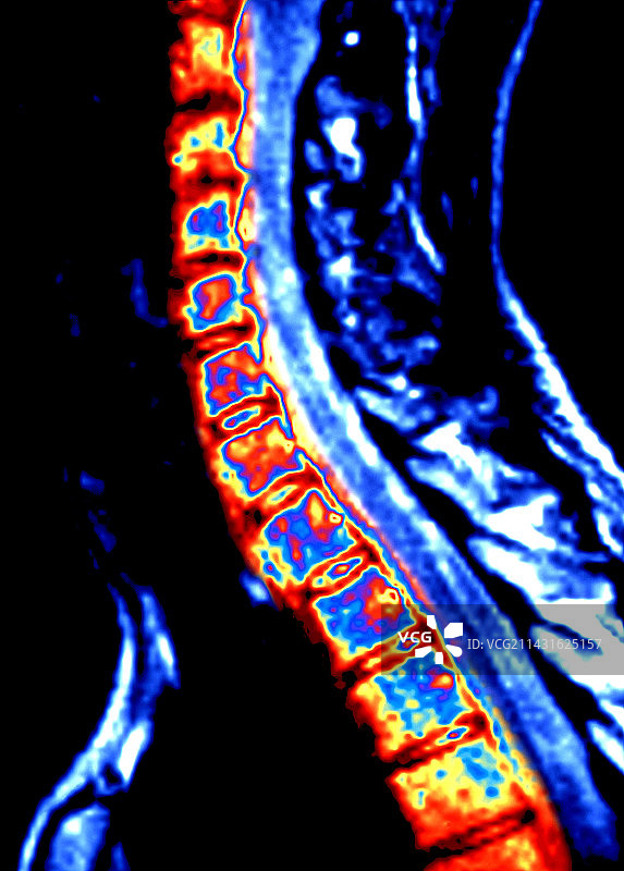 脊柱CT扫描图片素材