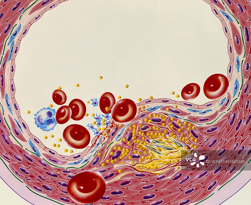动脉粥样硬化狭窄的艺术作品图片素材