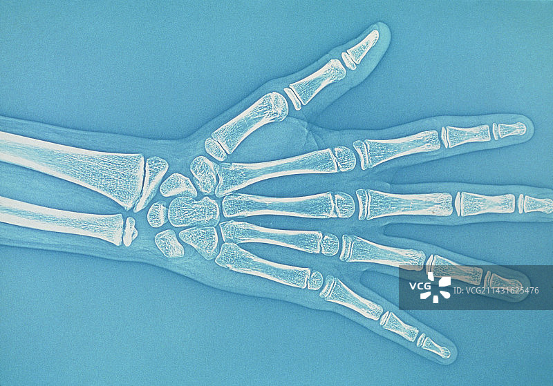 青少年手部X光片图片素材