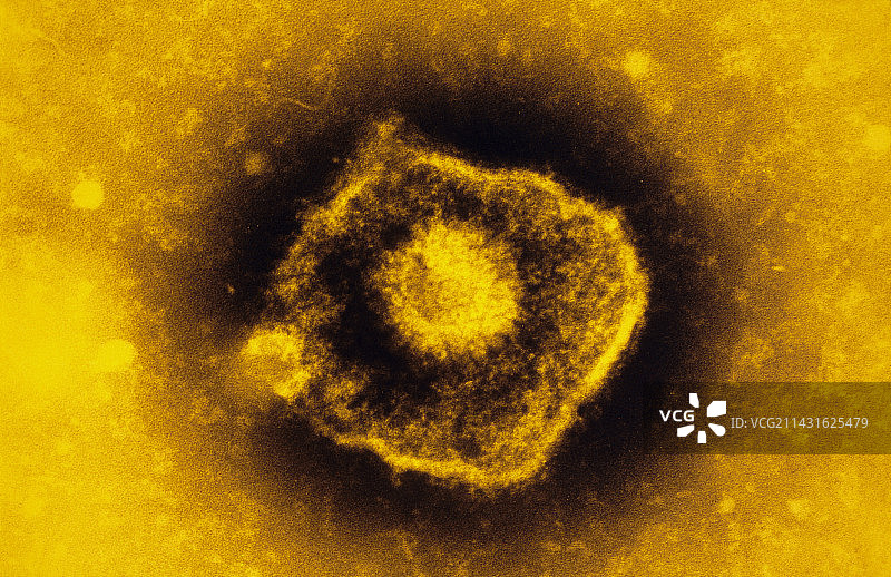 水痘-带状疱疹病毒的彩色透射电镜图图片素材