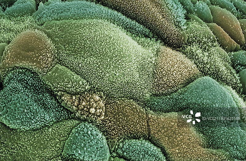 子宫癌图片素材