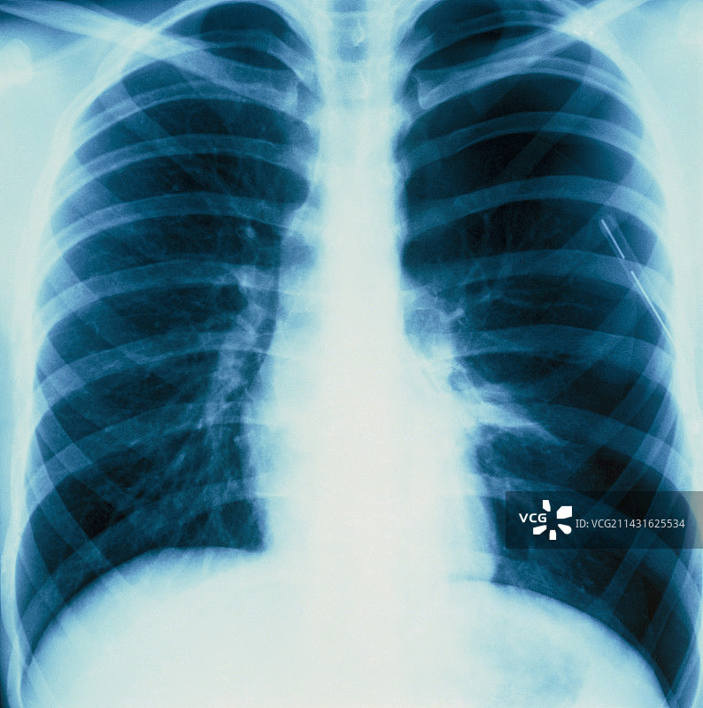 显示气胸肺部的X光片图片素材