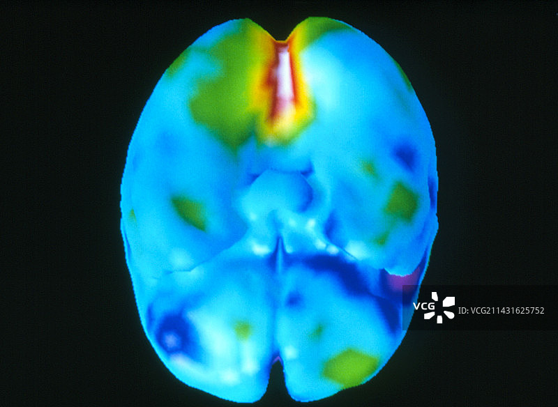 视觉活动期间的彩色3D PET脑部扫描图片素材