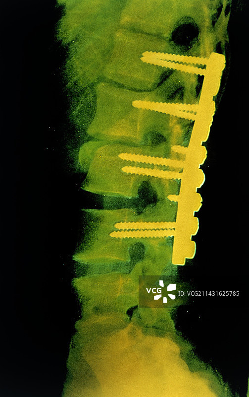 伪彩色人体脊柱侧面X射线图片素材