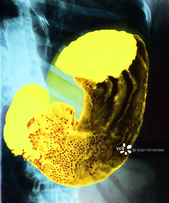 健康人胃部的彩色X光片图片素材