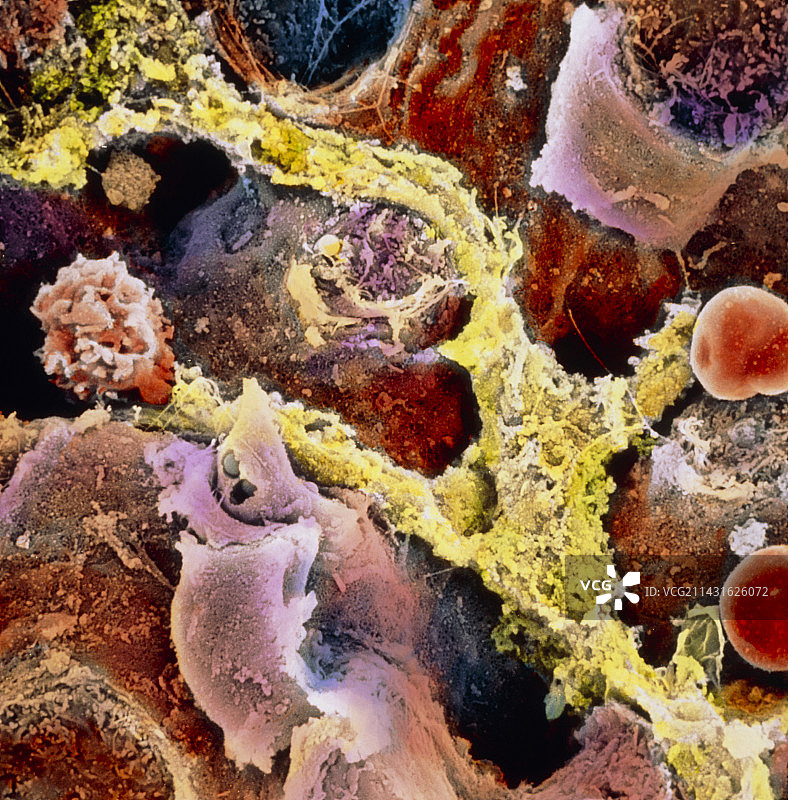 纤维化肝组织彩色扫描电镜图图片素材