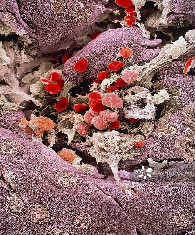 溃疡性结肠炎扫描电镜图图片素材