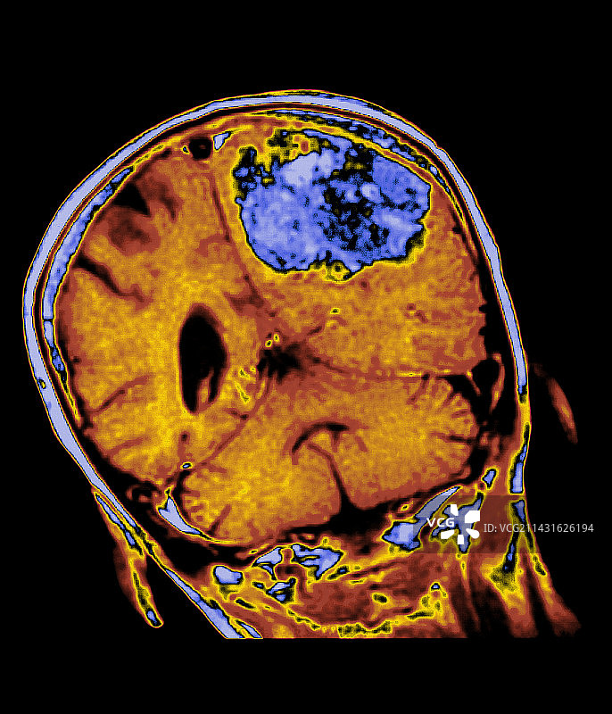 脑肿瘤图片素材