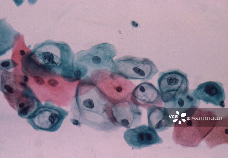 宫颈涂片显示HPV感染光镜图图片素材