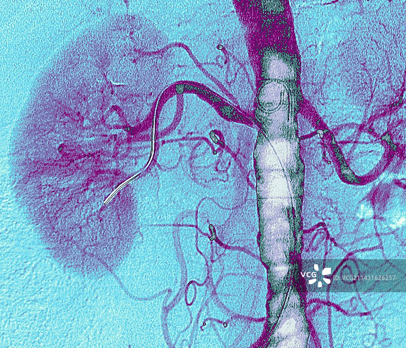动脉支架X光片图片素材