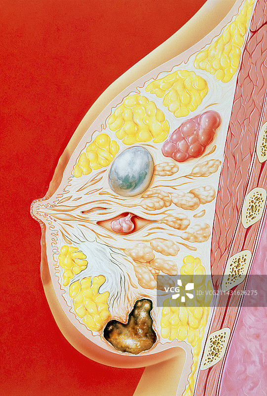 乳腺疾病插图图片素材