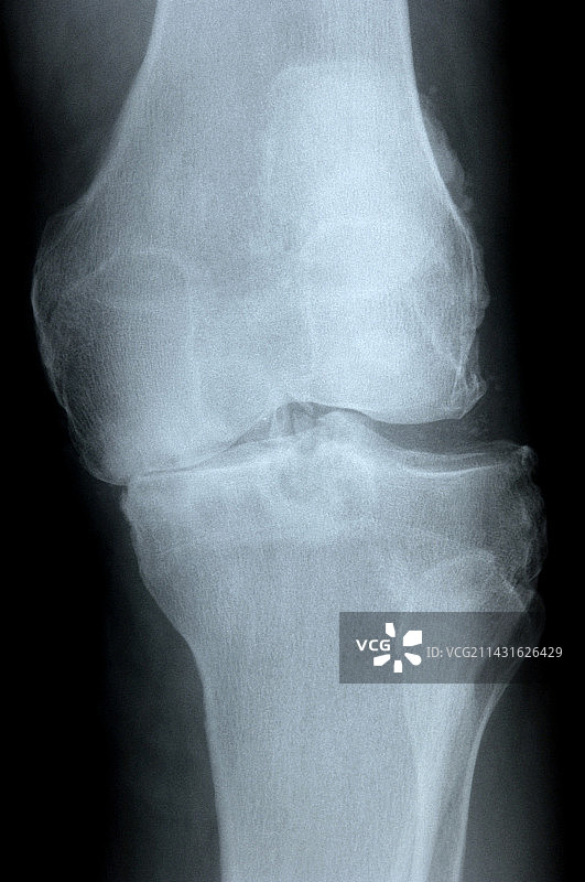 膝关节骨性关节炎X光片图片素材
