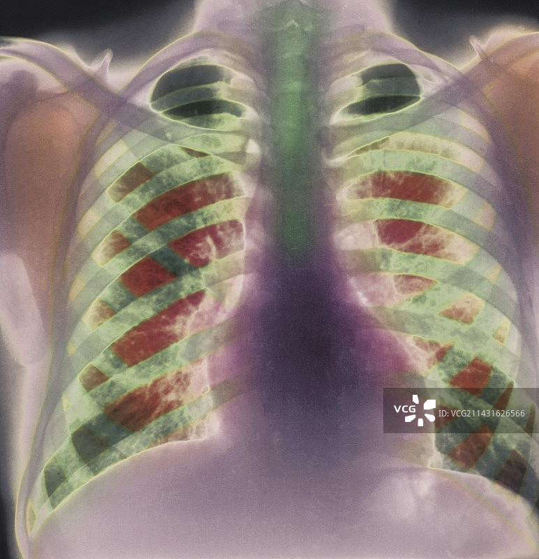 慢性支气管炎X光片图片素材