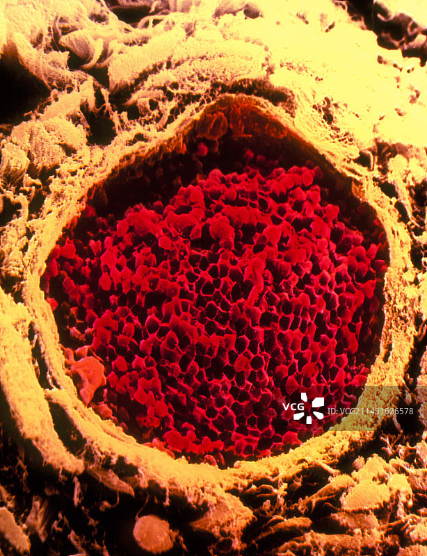 肺部闭塞血管的彩色扫描电镜图图片素材