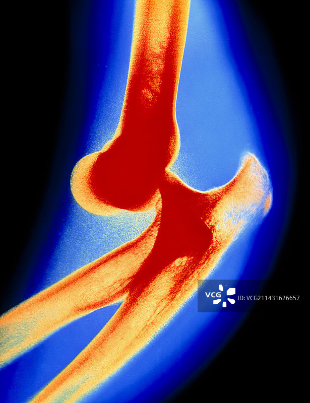 显示肘部脱臼的彩色X光图像图片素材