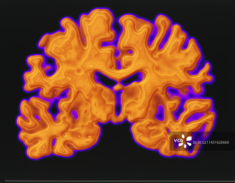脑部CT扫描图片素材