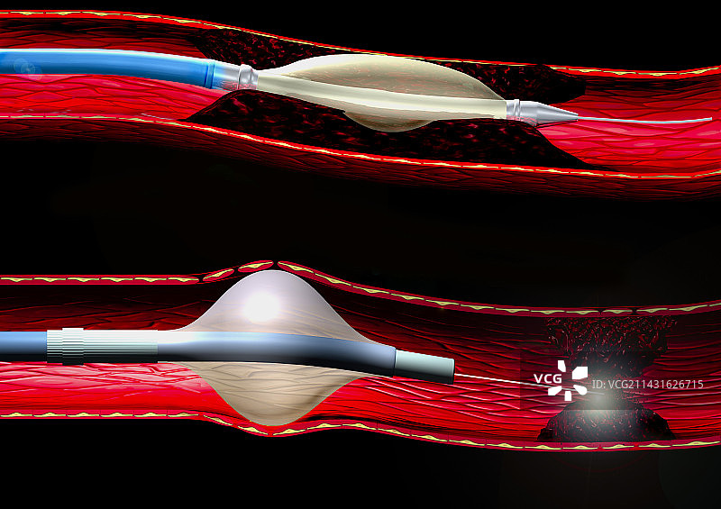 血管成形术技巧图片素材