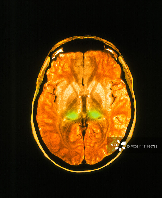 患有CJD的人脑彩色MRI扫描图片素材