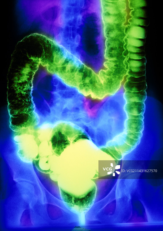 溃疡性结肠炎双重对比X射线图片素材