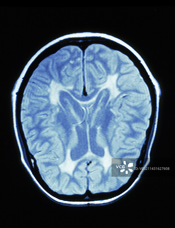 多发性硬化症脑部的MRI扫描图片素材