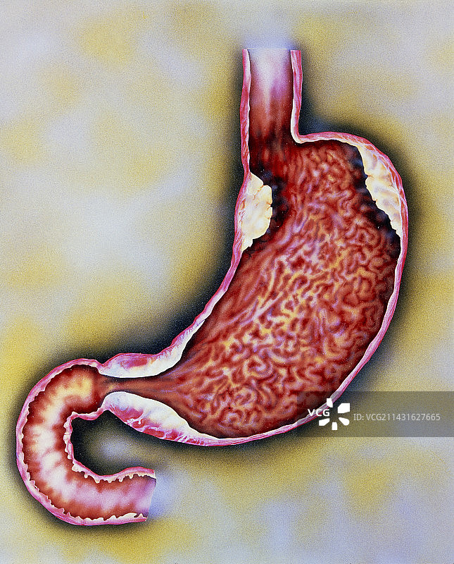 胃中不同癌症位置的艺术作品图片素材
