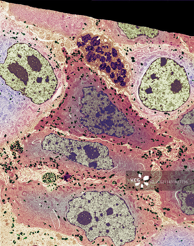 黑色素瘤癌细胞，TEM图片素材