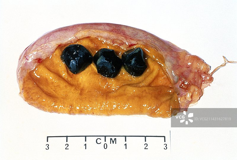切除的胆囊，显示3颗胆结石图片素材
