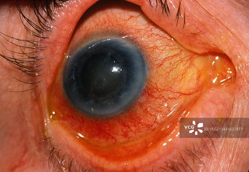 急性青光眼图片素材