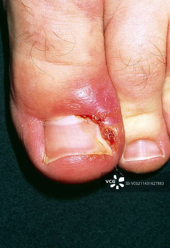 因趾甲向内生长引起的甲沟炎特写图片素材