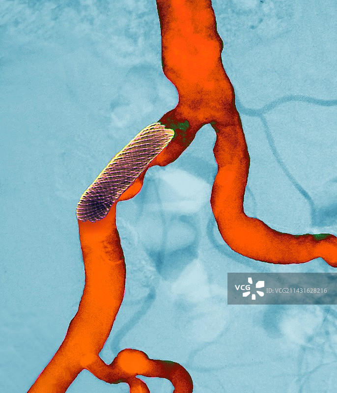 动脉支架X光片图片素材