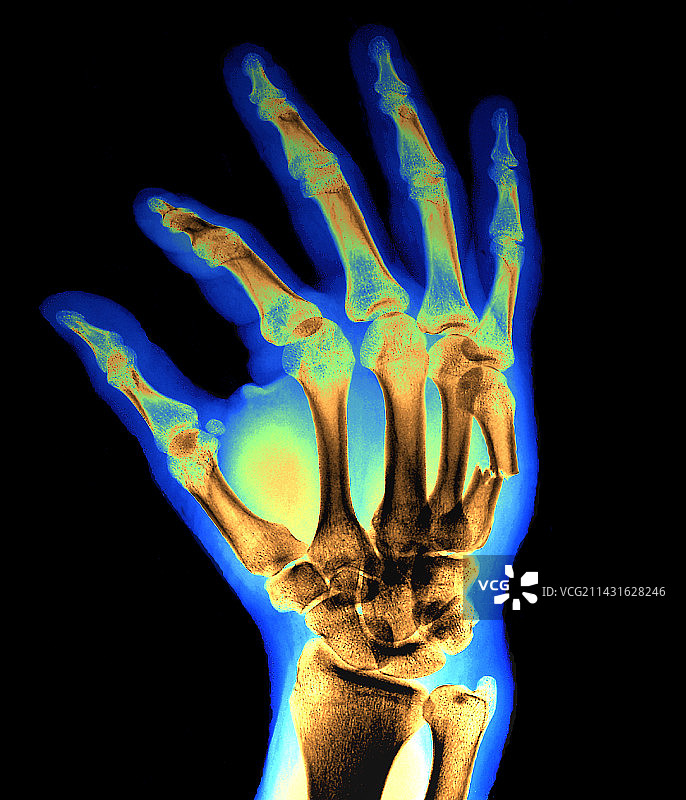 手部骨折X光片图片素材