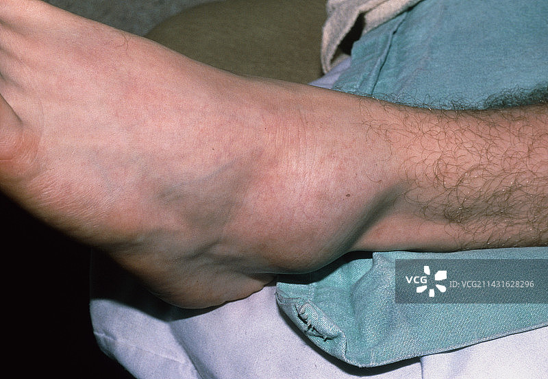 扭伤导致的左踝肿胀图片素材