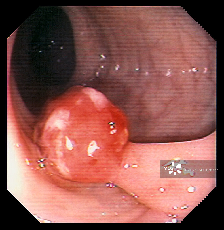 结肠息肉图片素材