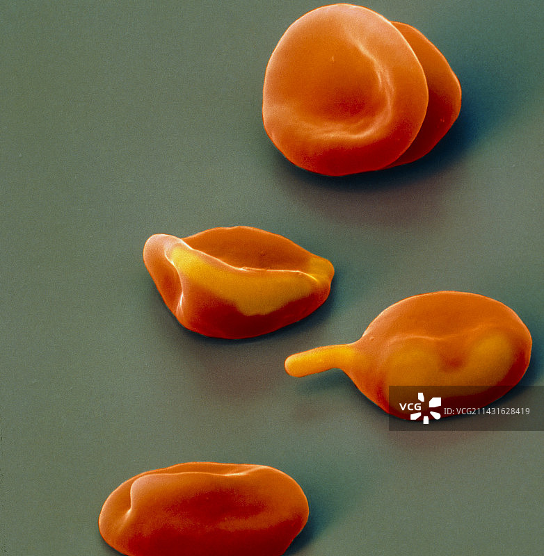 感染疟疾的红细胞的彩色扫描电镜图图片素材