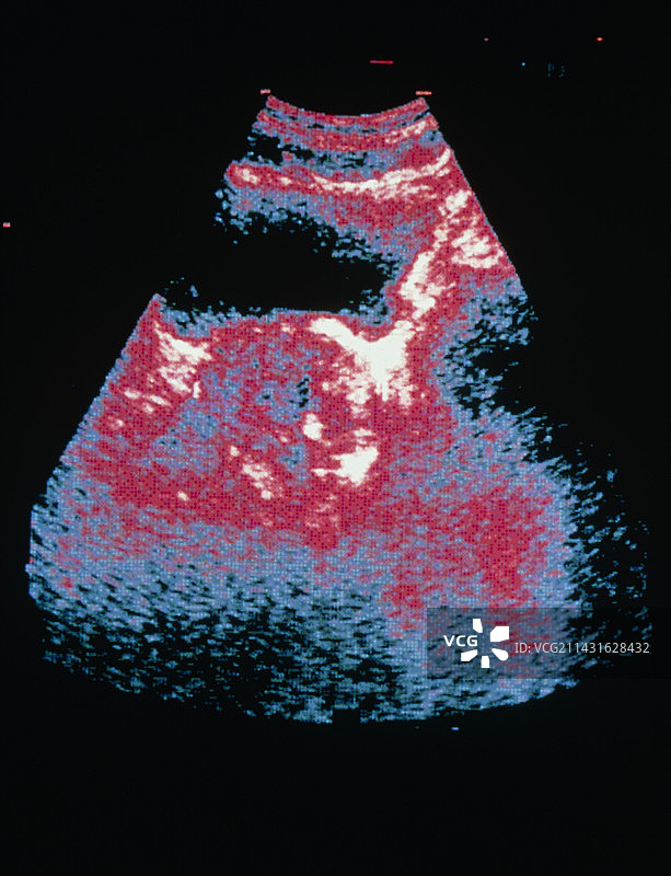 癌变前列腺超声图像图片素材