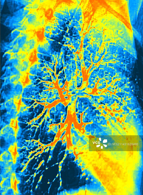 肺支气管图彩色X光片图片素材