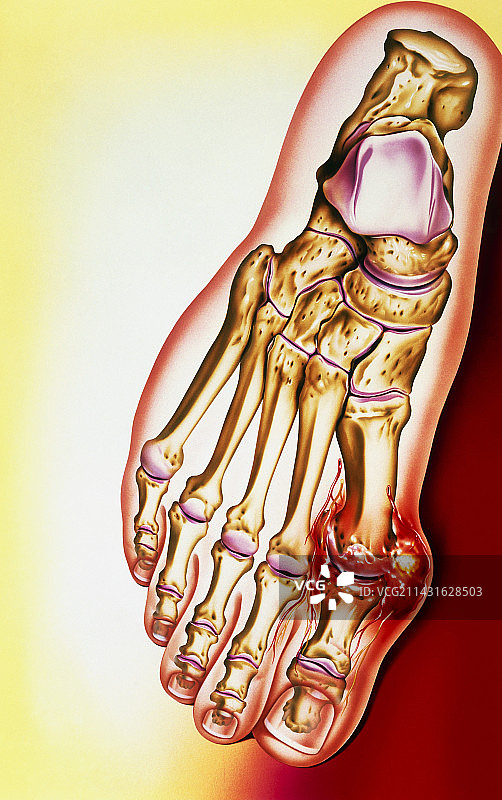 痛风示意图：大脚趾底部痛风石图片素材