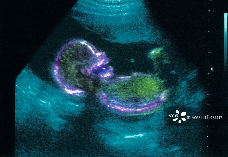 20周胎儿超声波扫描图片素材