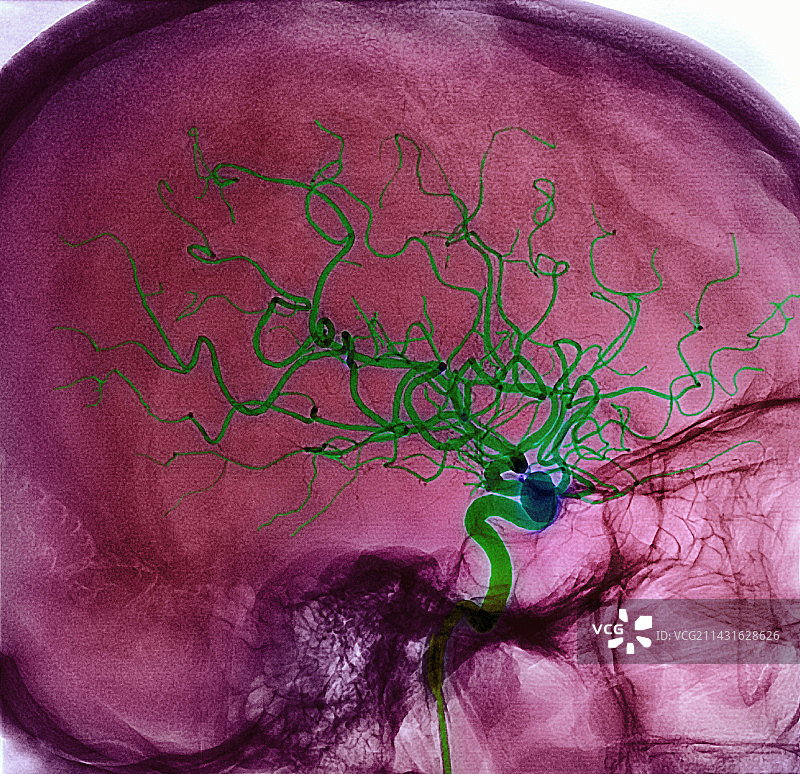 出血性中风损伤MRA扫描图片素材