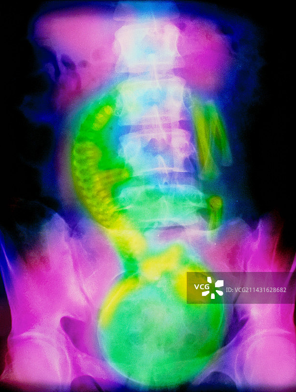 足月胎儿的彩色X光片图片素材