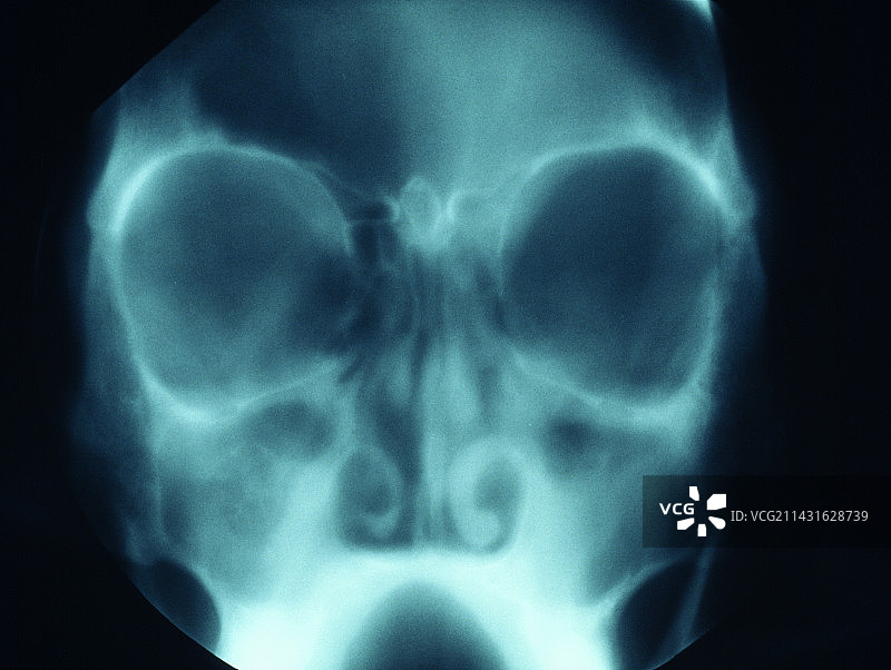 鼻窦炎症X光片图片素材