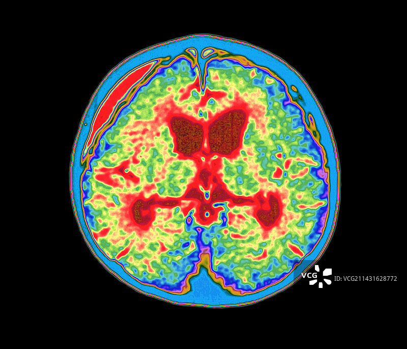 脑膜炎脓肿的彩色核磁共振脑部扫描图片素材