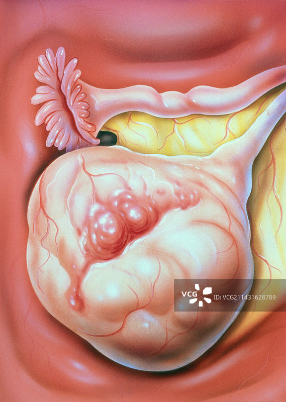 卵巢癌插画图片素材