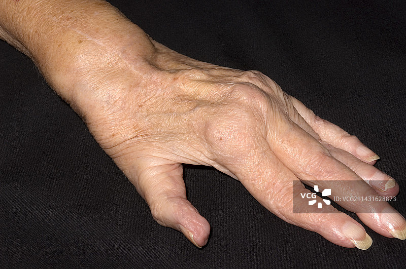 类风湿性关节炎图片素材