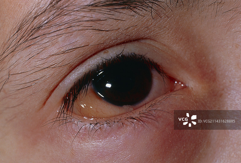 因花粉过敏反应引起的眼睛发炎图片素材